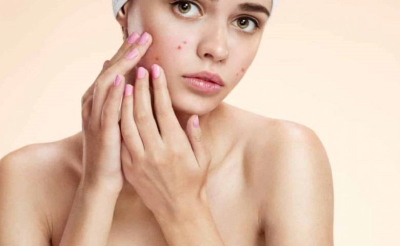 bôi kem chống nắng bị nổi mụn