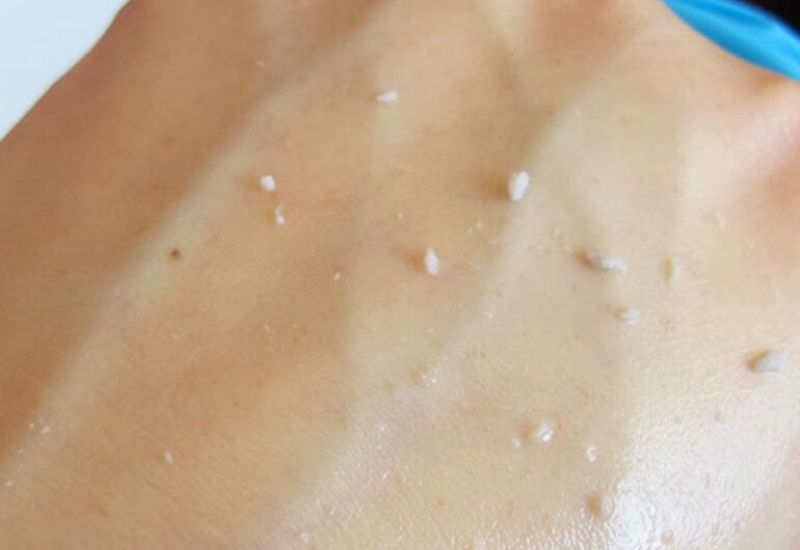 tại sao bôi kem chống nắng bị ra ghét