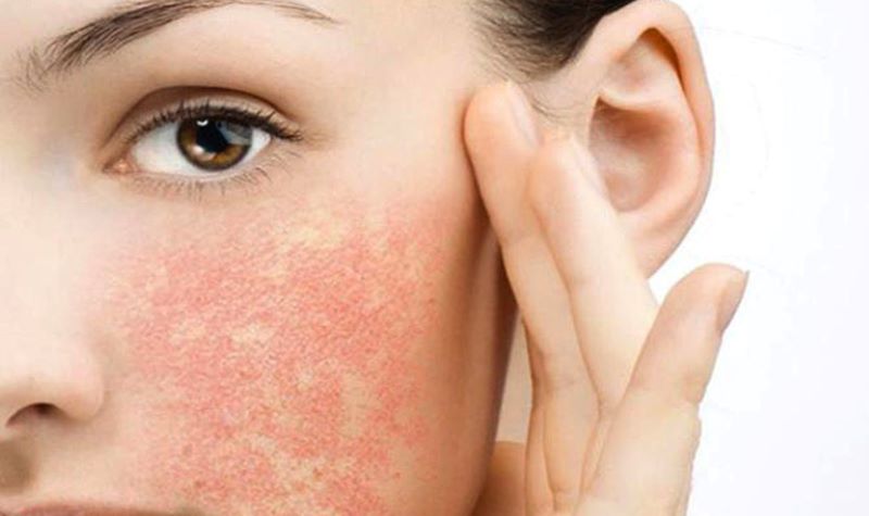 dị ứng kem chống nắng