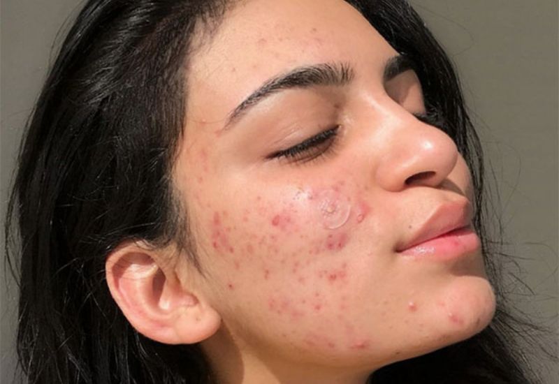 tác hại của việc không bôi kem chống nắng