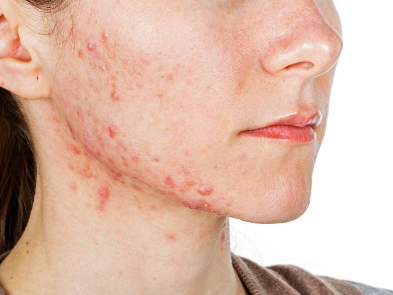 da bị dị ứng kem chống nắng
