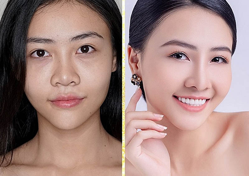 cách tạo khối cho mũi to