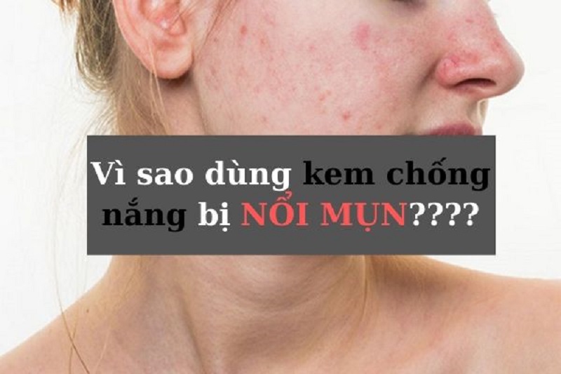 tại sao bôi kem chống nắng bị nổi mụn