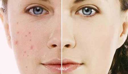 Hết tự ti với 5 cách che mụn không cần trang điểm siêu đỉnh