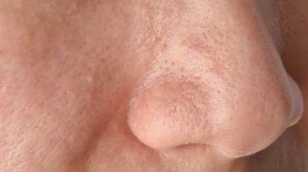 7 cách làm mặt nạ trị mụn đầu đen hiệu quả ngay từ lần đầu