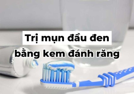 Thực hư Cách trị mụn đầu đen bằng kem đánh răng & lưu ý cần biết